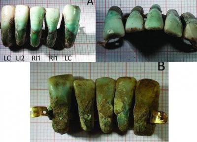 کشف دندان مصنوعی 400 ساله در ایتالیا