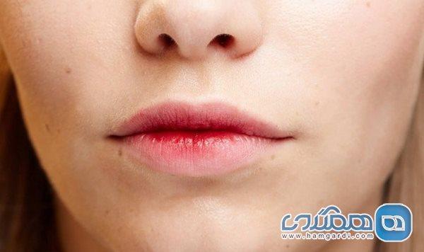 تغییر رنگ لب ها نشانه کدام بیماری است؟