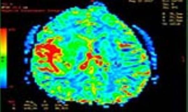 مقدار امید به زندگی در مرحله 4 سرطان مغز