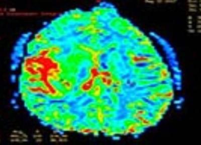 مقدار امید به زندگی در مرحله 4 سرطان مغز